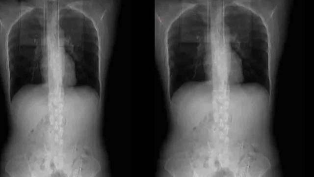 ঝাল খেয়ে ভেঙে গেল নারীর পাঁজরের হাড়