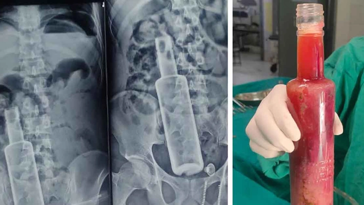 অস্ত্রোপচারে পেট থেকে বের হলো আস্ত মদের বোতল অস্ত্রোপচারে পেট থেকে বের হলো আস্ত মদের বোতল