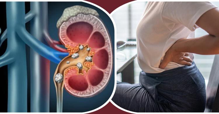 তরুণদের মধ্যে কেন বাড়ছে কিডনিতে পাথর হওয়ার ঝুঁকি? তরুণদের মধ্যে কেন বাড়ছে কিডনিতে পাথর হওয়ার ঝুঁকি?